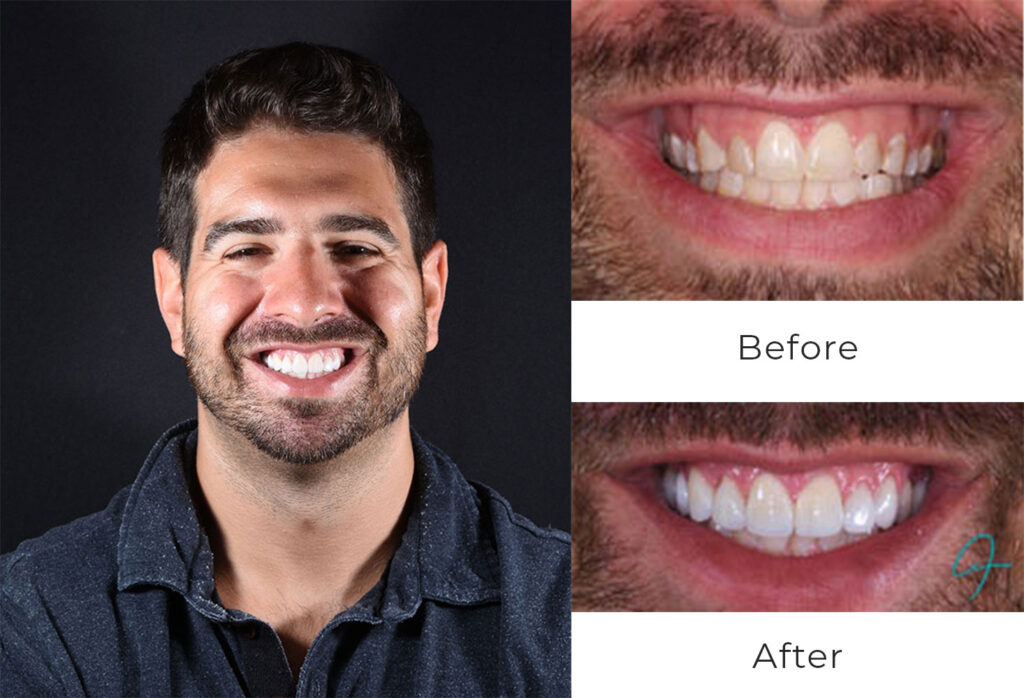 Before & After | Dental Implants Patient