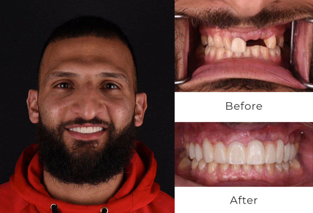 Before & After | Dental Implants Patient