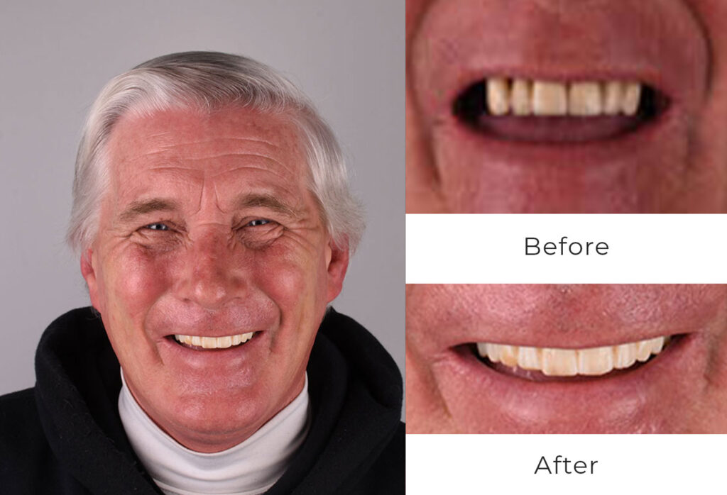 Before & After | Dental Implants Patient
