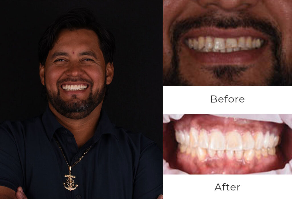 Before & After | Dental Implants Patient