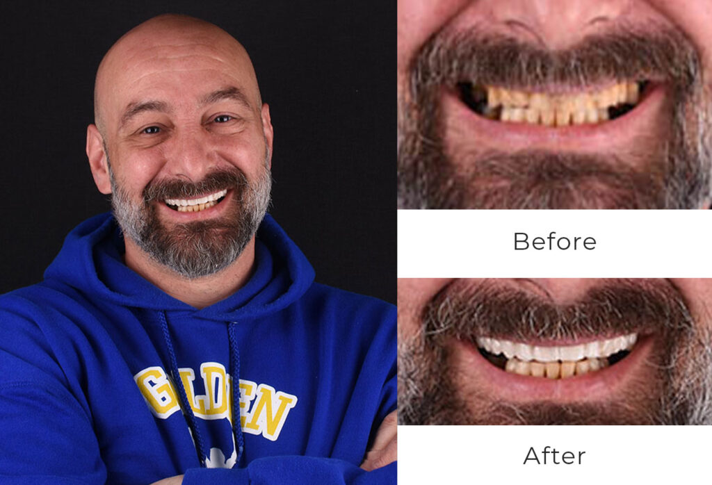 Before & After | Dental Implants Patient