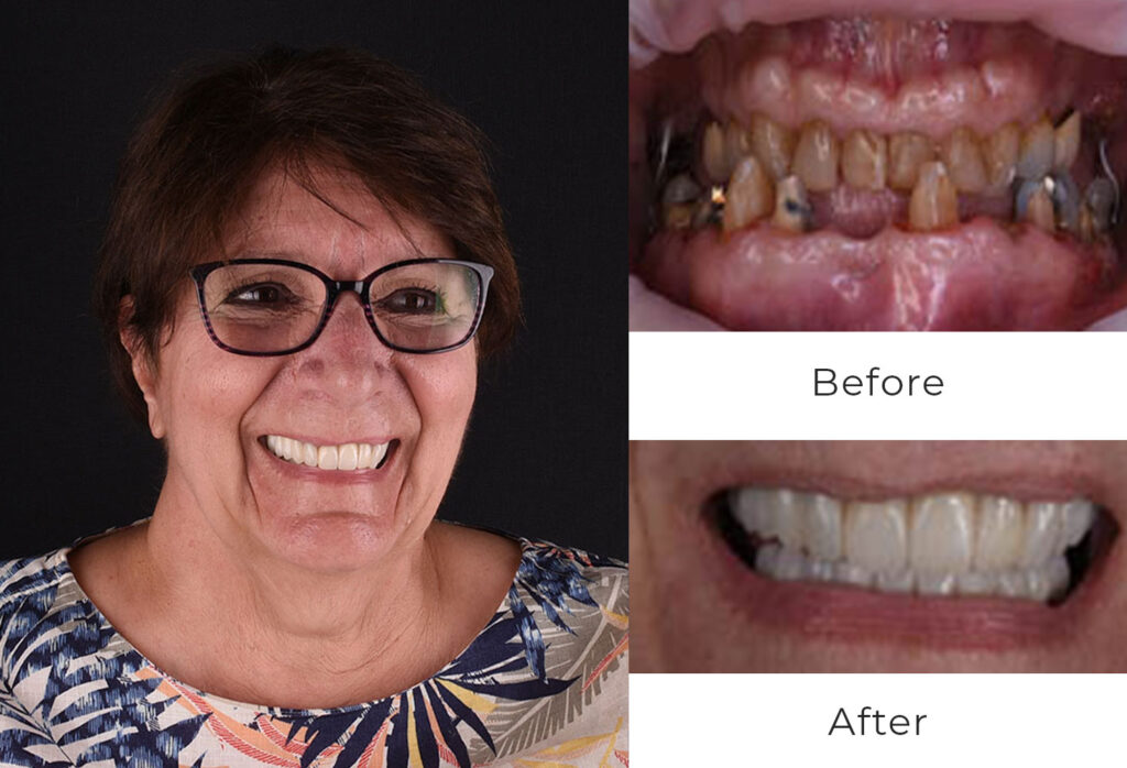 Before & After | Dental Implants Patient