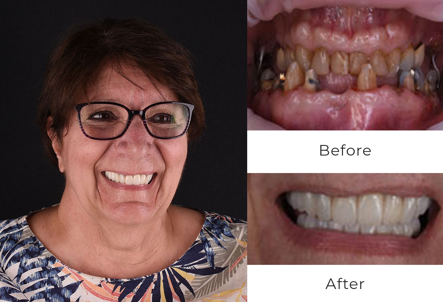 Before & After | Dental Implants Patient